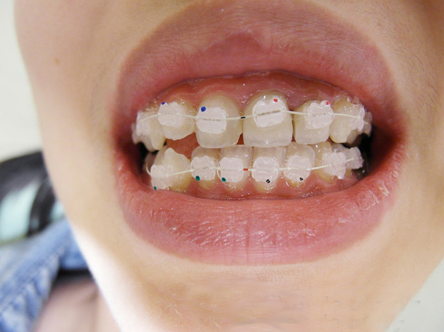 牙套有邊D類型？