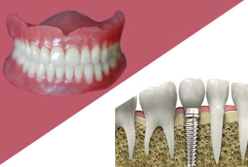 牙種植體vs假牙