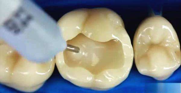 補牙真個會導致洞越嚟越大？