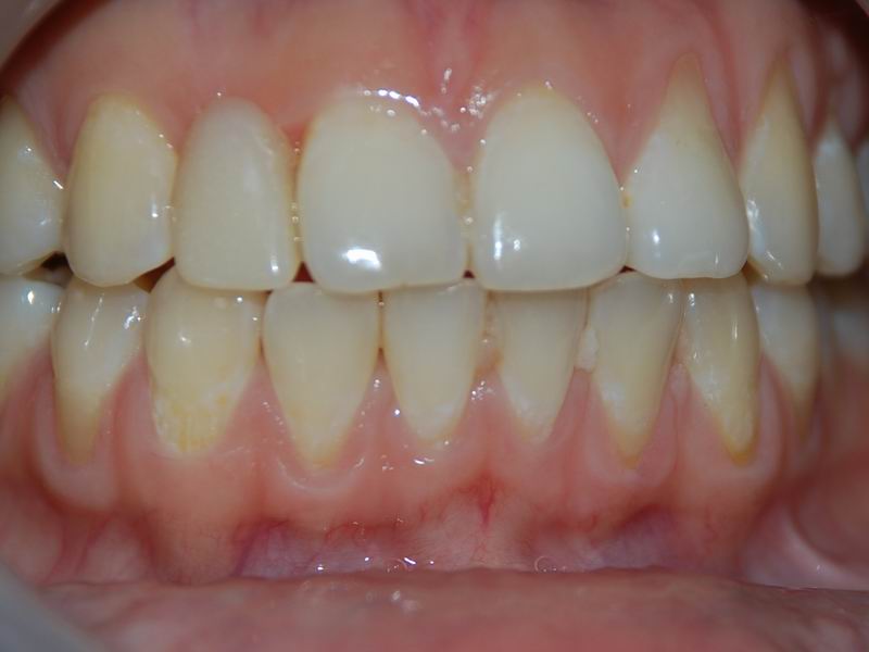 前牙種植成功案例