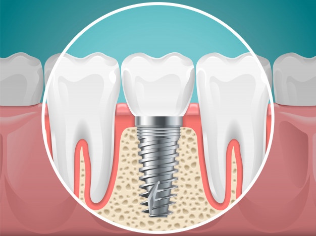 做種植牙有什麽危害？怎樣降低種植牙手術風險？