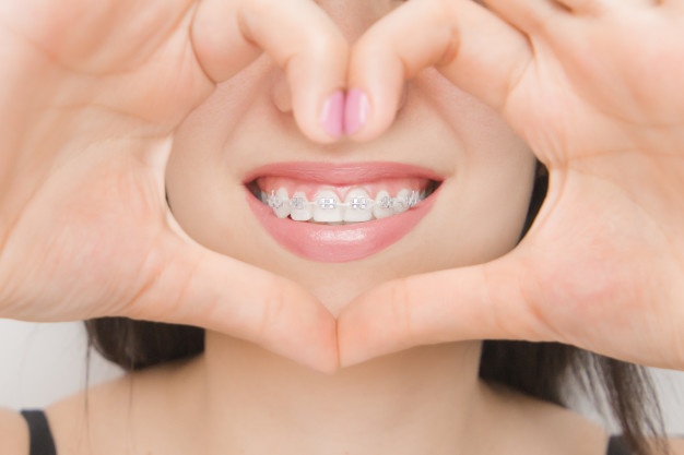 唇側和舌側矯正哪個快？牙齒矯正唇側和舌側區別有哪些