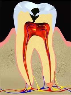 智慧齒碰上急性牙髓炎，直接剝除還係開髓後再剝除？