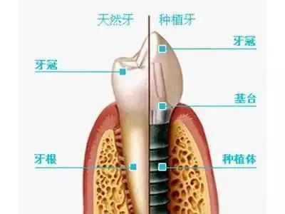 口腔種牙超詳細介紹，患者再問就用佢！