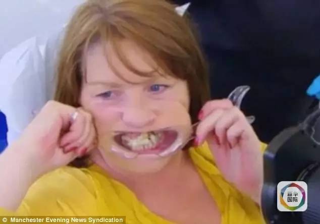 女子唔睇牙醫，十年來用強力膠水黏斷牙驚嚇牙醫！