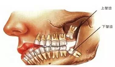生智慧齒點解會痛？？？