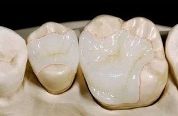 補牙用咗嵌體點解會脫？