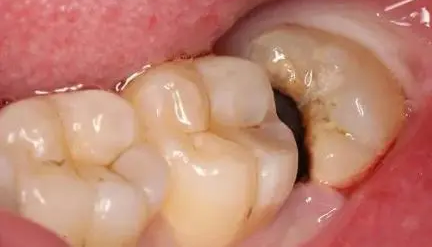 埋伏牙和阻生牙有何區別？
