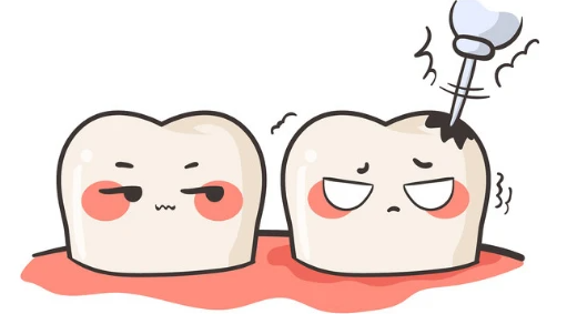點解後牙根管治療比前牙貴？