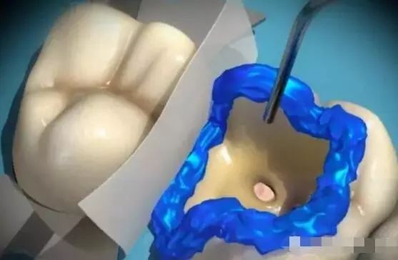 點解牙醫都推薦嵌體補牙？