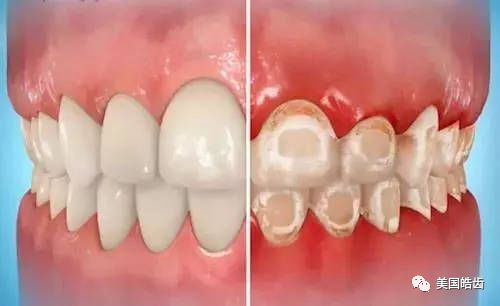 箍牙期間牙齒清潔好重要，清潔過程工具都好重要！