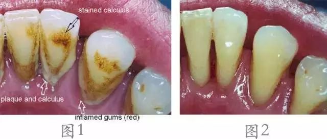 爲什麼都係洗牙，價格卻唔一樣？瞭解一下哩4種洗牙技術