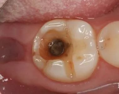牙齒都爛咗剩一半，爲何仲不能直接補牙？