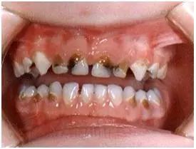 爲什麼孩子新長出嘅牙都係小黑牙？