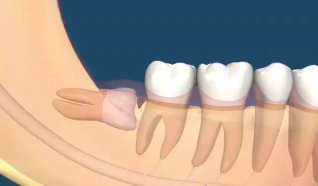 點解大部分智慧齒需要剝除？