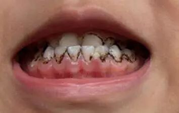 小朋友牙齒上嘅黑色素能去除嗎？