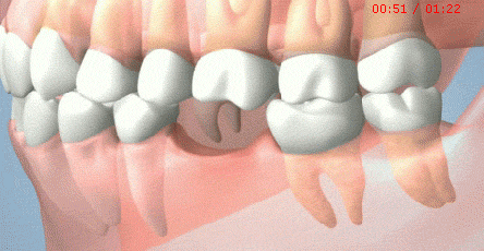 為什麼我缺咗一顆牙，醫生卻要鑲我三顆？