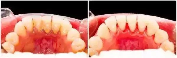爲什麼你會有洗牙後牙結石會生得更快嘅錯覺呢？