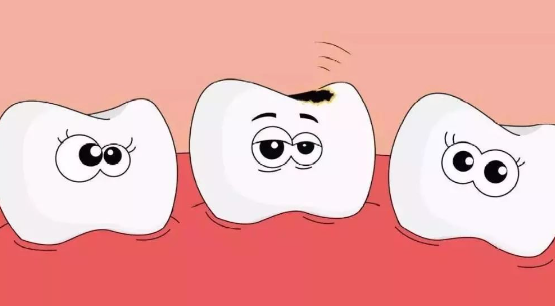 牙齒楔狀缺損點樣補先可以夠牢固