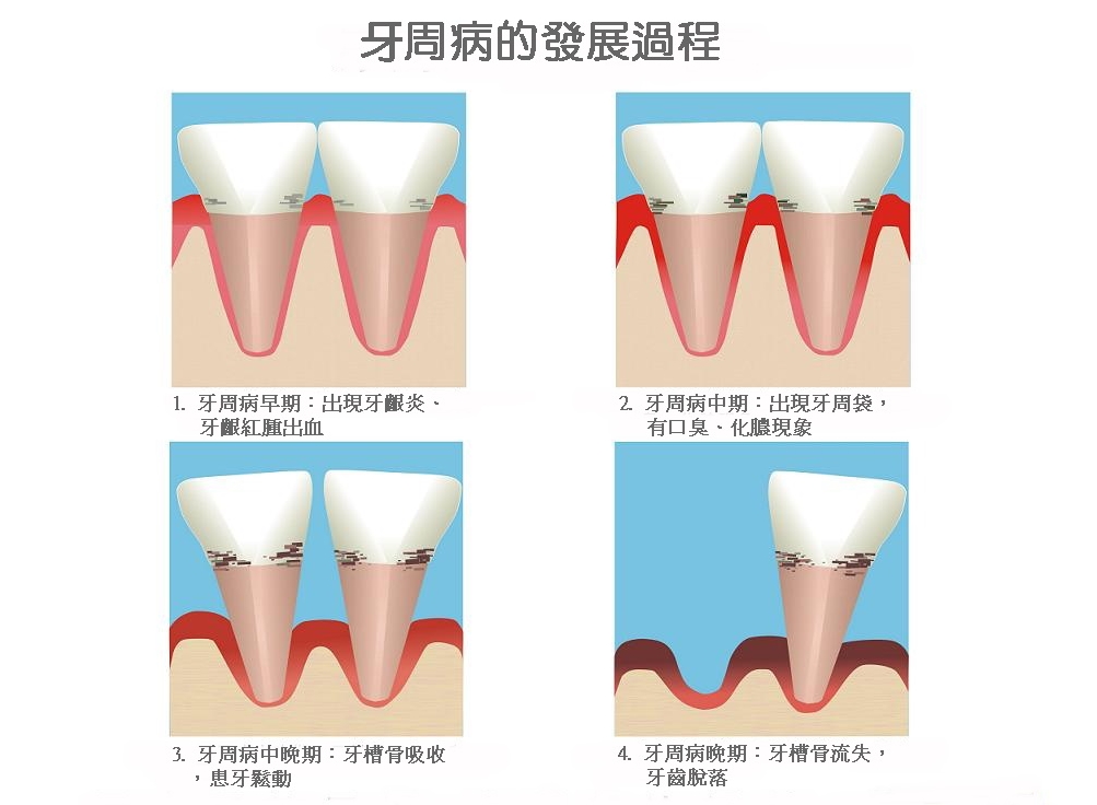 牙周病預防方法