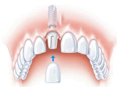 種植牙系乜?