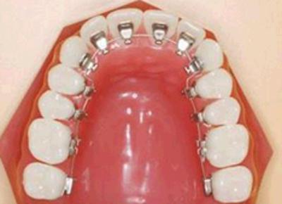 深圳牙齒矯正邊度平？
