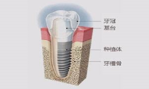 種植牙嘅壽命有多長？能用多久？會唔會用幾年就「壞」掉了？