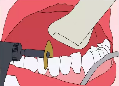 鑲牙同種牙嘅區別系乜？