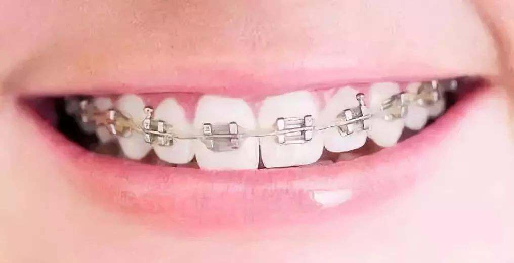 牙齒正畸嘅方法有邊啲？