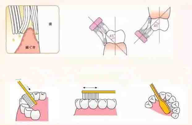 深圳隱形箍牙後嘅牙齒清潔方法