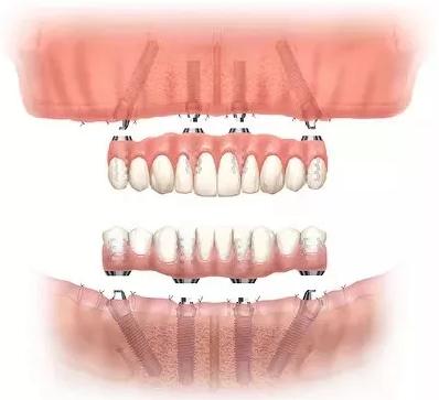 牙齒全口缺失點算？唔怕，ALL-on-4(6)嚟幫你