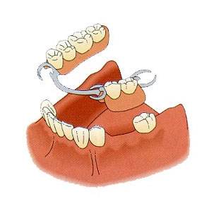 假牙嘅使用壽命系幾耐？假牙會過期？