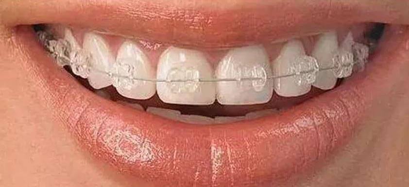 箍牙可以做半口嗎?