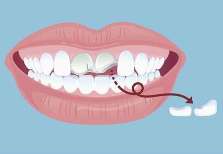 牙齒摔斷了半截怎麼辦？