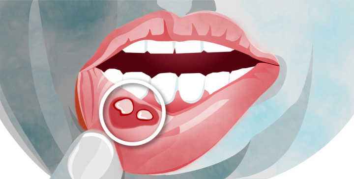 經常口腔潰瘍有什麼好的治療方法？