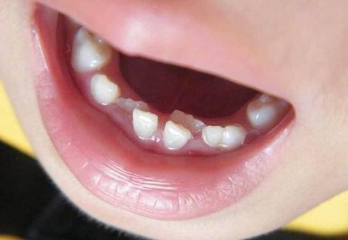 如何緩解寶寶第一次長牙的疼痛
