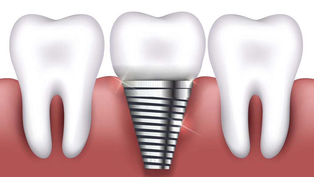 種植牙費用相對高，那是有原因的！
