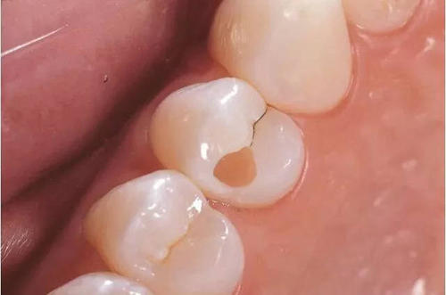 蟲牙真的是有蟲子在咬牙齒嗎？