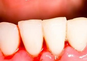牙齒出血怎麼辦？