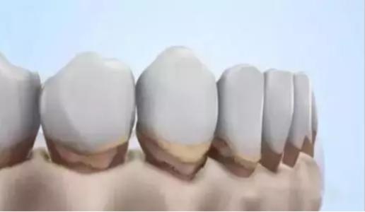 為什麼牙齦會退縮？