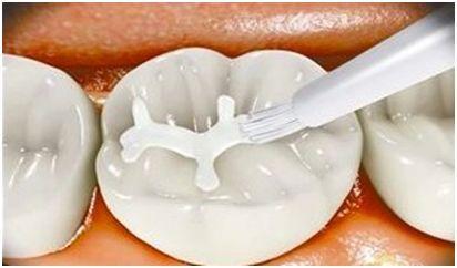 乳牙蛀牙嚴重，但是牙不疼，需要“殺神經”嗎？