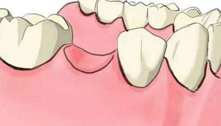 牙齒“缺席”后，不鑲牙會怎麼樣？後果比你想的嚴重