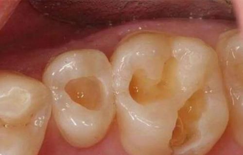為什麼乳牙蛀牙也要補？這張圖就是最好的答案