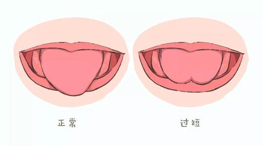 舌系帶過短影響大！如何判斷舌系帶短不短？該不該剪？