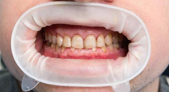 維港齒科中心——洗牙傷牙嗎？