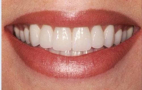 維港齒科中心——三種牙齒美容方法大對比