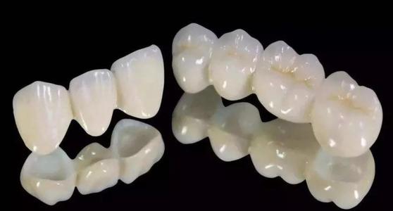 維港齒科中心——全瓷貼面 修復牙齒上的小瑕疵