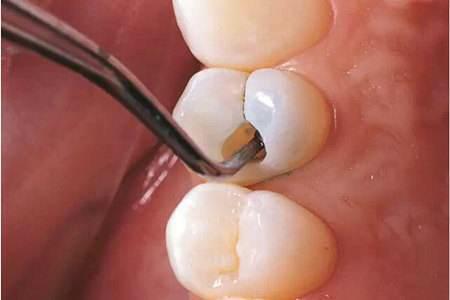 維港齒科中心——牙齒疼痛難忍，該如何是好？