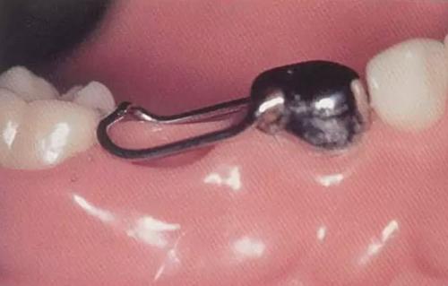 維港齒科中心——間隙保持器：乳牙早缺的好幫手