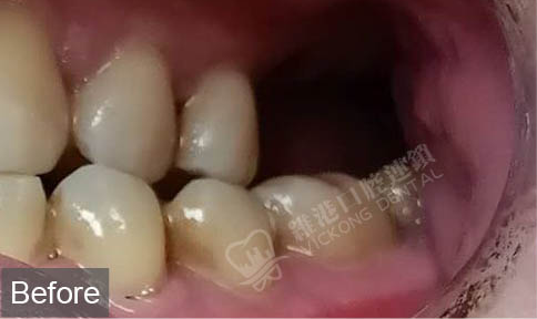 深圳陳先生左上磨牙缺失種植修復案例